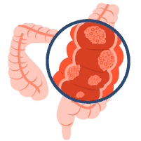 大腸癌