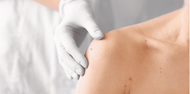 what-is-skin-cancer