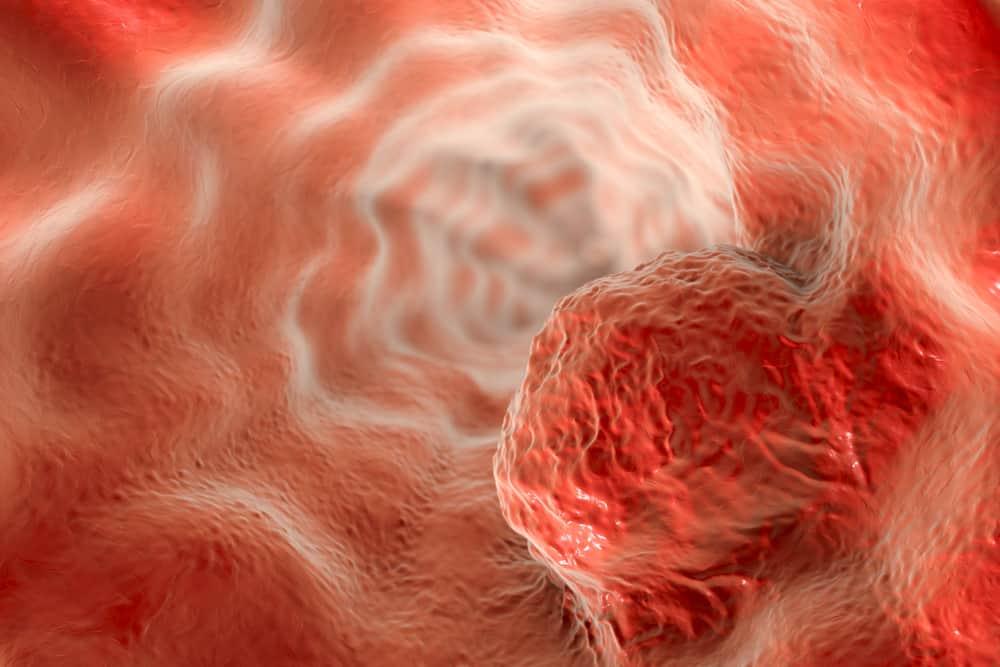 what-is-tumor